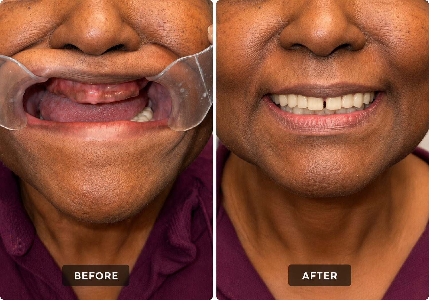 Upper Arch Restoration before and after denture transformation