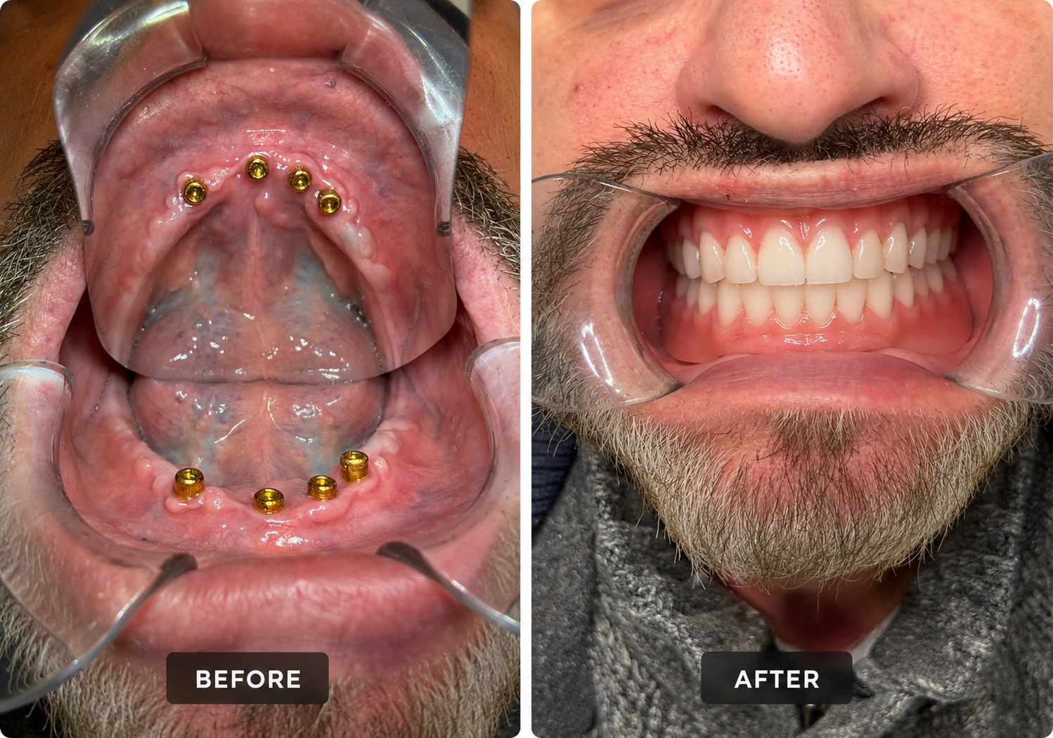 Full Upper & Lower Restoration before and after denture transformation
